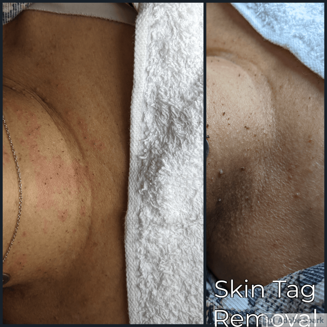 Skin Tag Removal Philadelphia Remove Skin Tags From Face Neck Etc